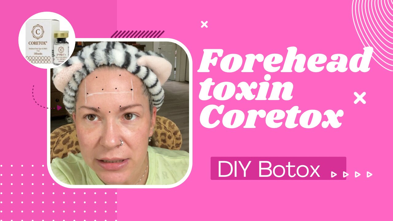 Forehead toxin and mapping | diy Botox using Coretox