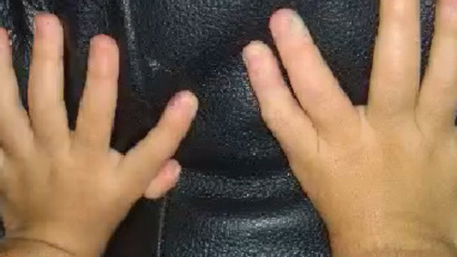 Caldwell family asking for help to help daughter born with extra fingers and toes