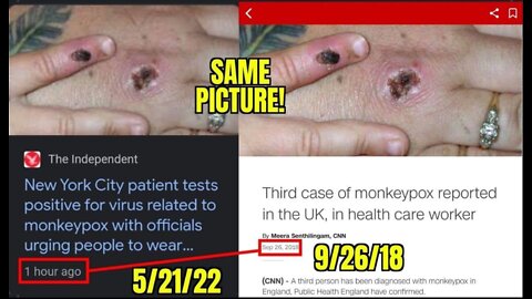 Why Is Monkeypox Spreading So Fast?