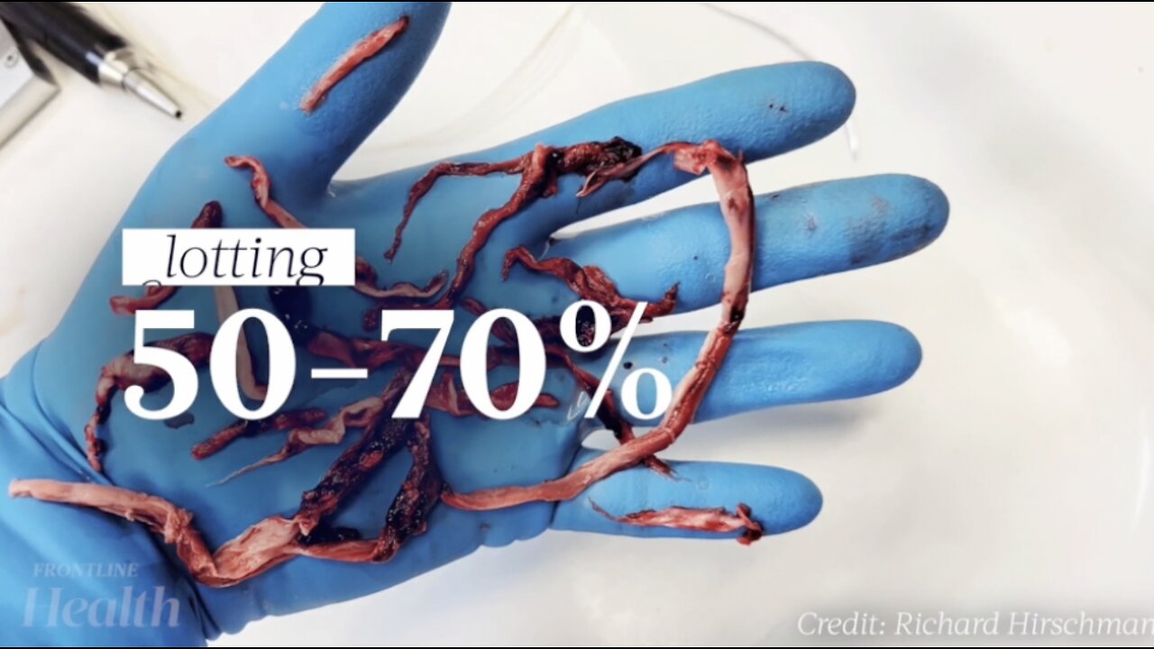 Funeral Director: Mystery Clots Appear in 50–70 Percent of Deceased