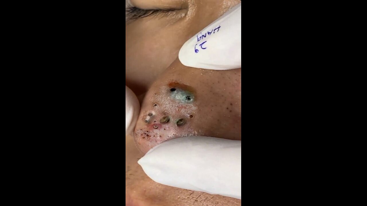 blackhead