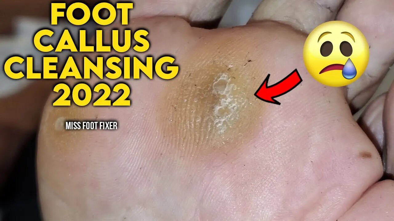 FOOT CALLUS REMOVAL 2022 (PAINLESS PROCEDURE) | SATISFYING CALLOUS TREATMENT BY MISS FOOT FIXER