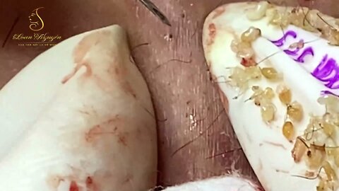 Loan Nguyen Spa acne treatment and removal blackheads (654) #blackheads #acnetreatment #acne