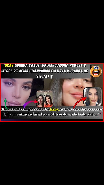 #gkay revela: A influenciadora que reverteu harmonização facial com 3 litros de ácido hialurônico!
