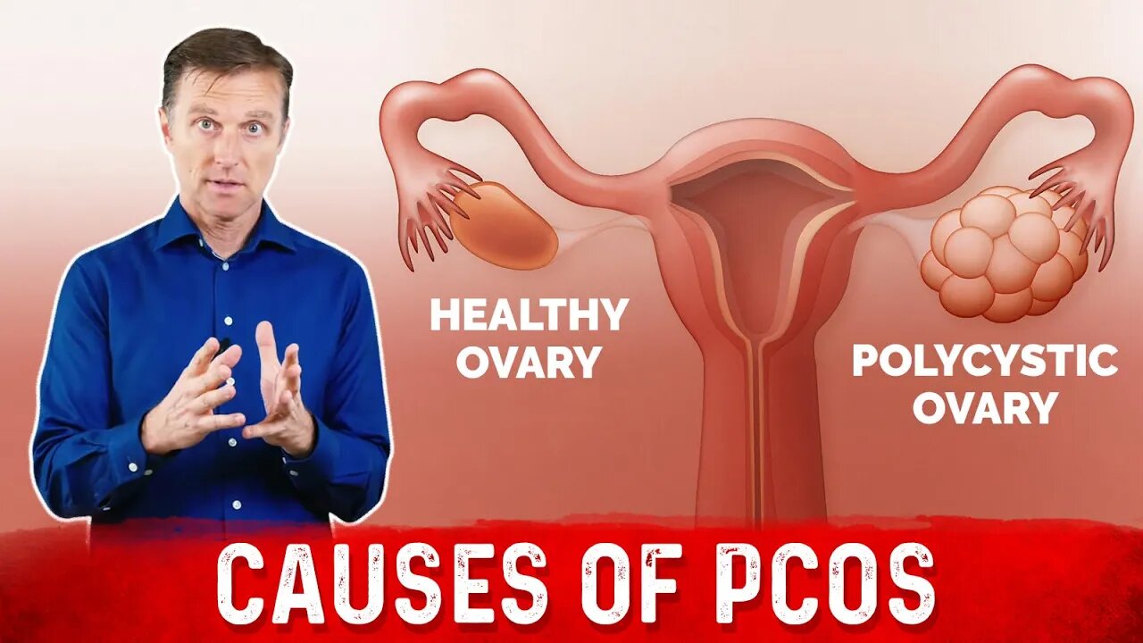 3 Causes of Polycystic Ovarian Syndrome (PCOS) & High Androgens – Dr. Berg