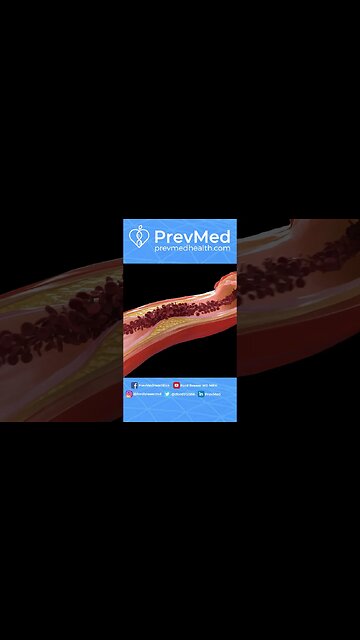 #SHORTS Can This Supplement Cause Plaque?