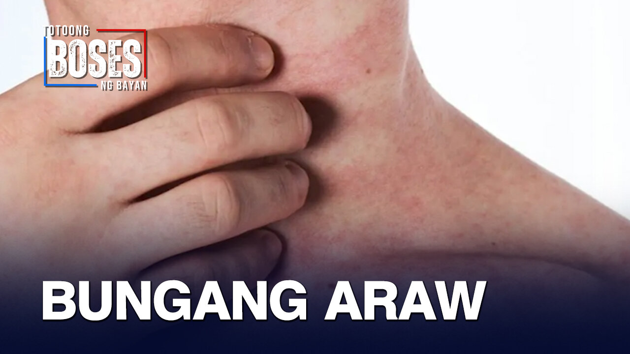 Health expert, nagpaalala para iwas bungang araw ngayong tag-init