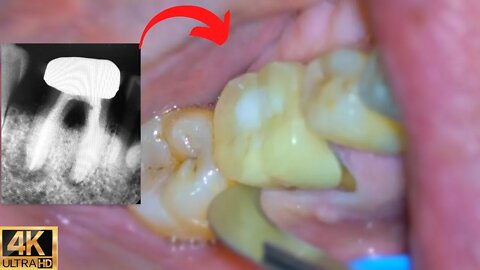 Surgical Tooth Extraction w/ Microscope (LIVE)