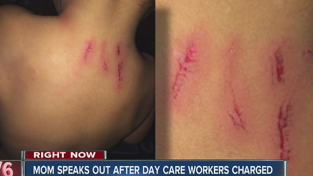 Mother speaks out after toddler injured by 11-year-old at day care