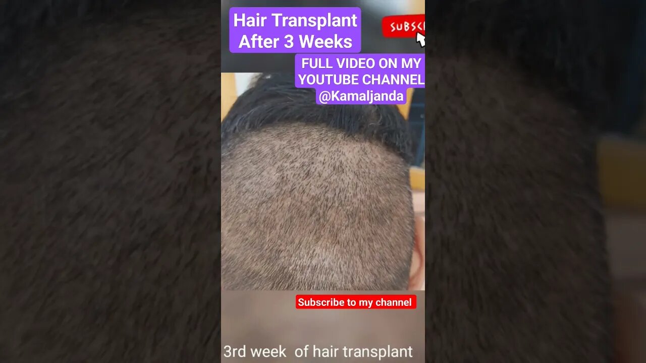 Hair Transplant -Everything You need to know