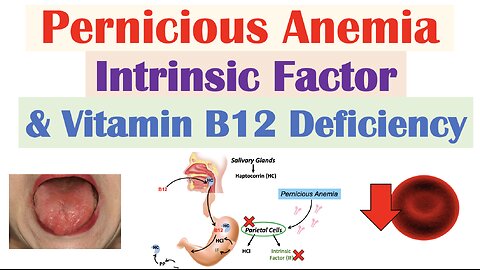 Pernicious Anemia (Rare Cause of Vitamin B12 Deficiency) | Causes, Symptoms, Diagnosis, Treatment