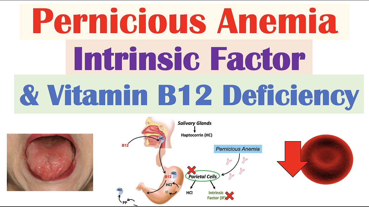 Pernicious Anemia (Rare Cause of Vitamin B12 Deficiency) | Causes, Symptoms, Diagnosis, Treatment