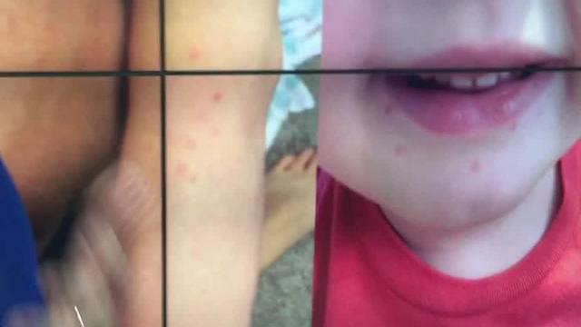 Digital Short: Hand, Foot and Mouth Disease concerns growing in Tampa Bay area