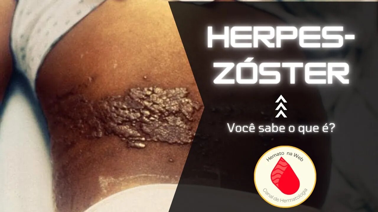 Que DOR é essa? Saiba mais sobre HERPES-ZÓSTER! | Geydson Cruz; MD,MSc