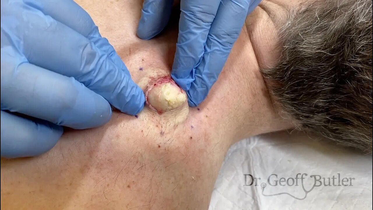 Cyst Plot Twist!