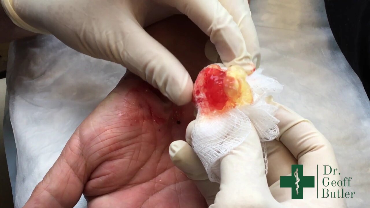 Drainage of Huge Ganglion Cyst