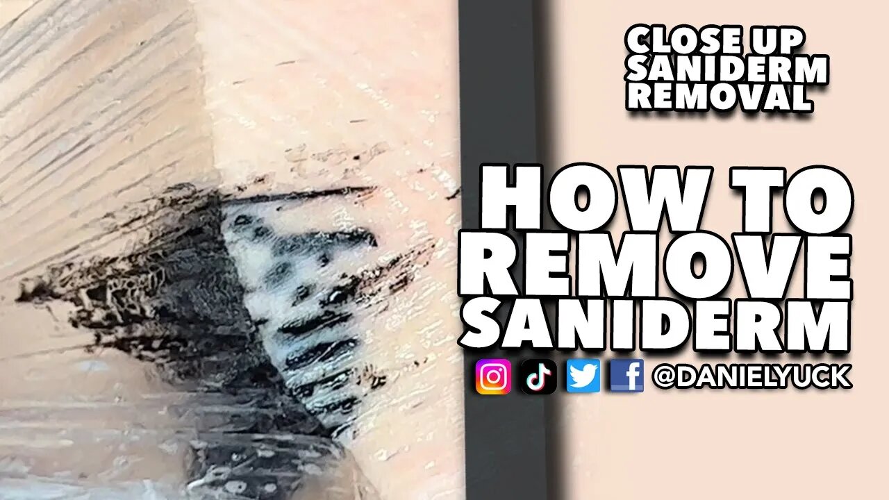 How To Remove Saniderm?