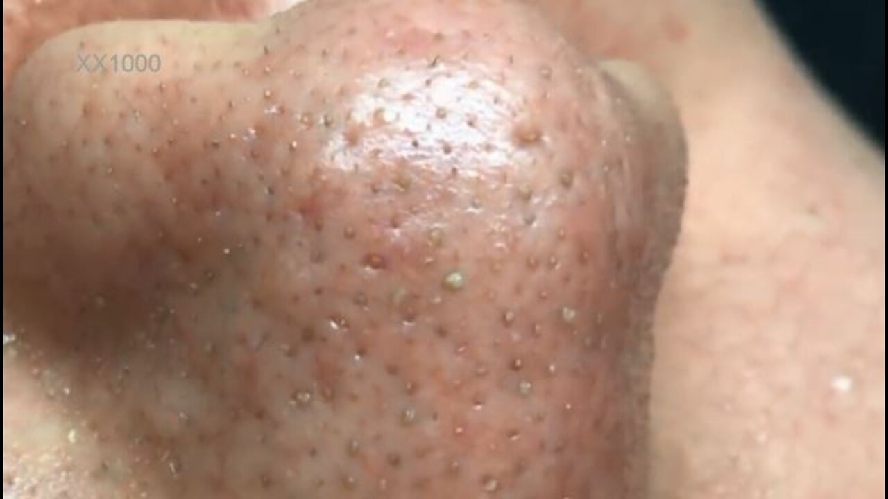 remove blackhead on face