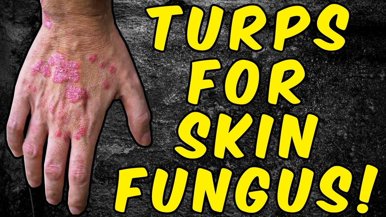 How To Eliminate Skin Candida/Fungus With Turpentine!