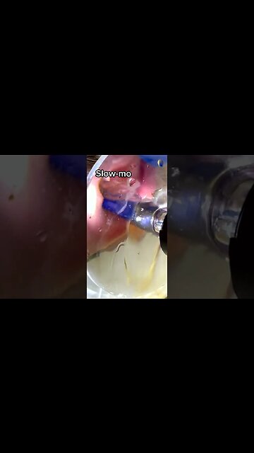 Newest pimple removal 2023 Cystic acne extractions whiteheads new