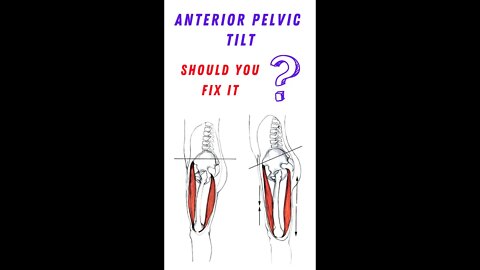 How to fix anterior pelvic tilt?