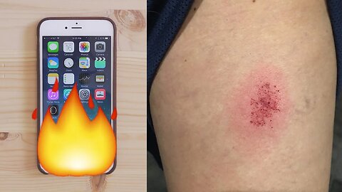 iPHONE BURNS LEG!