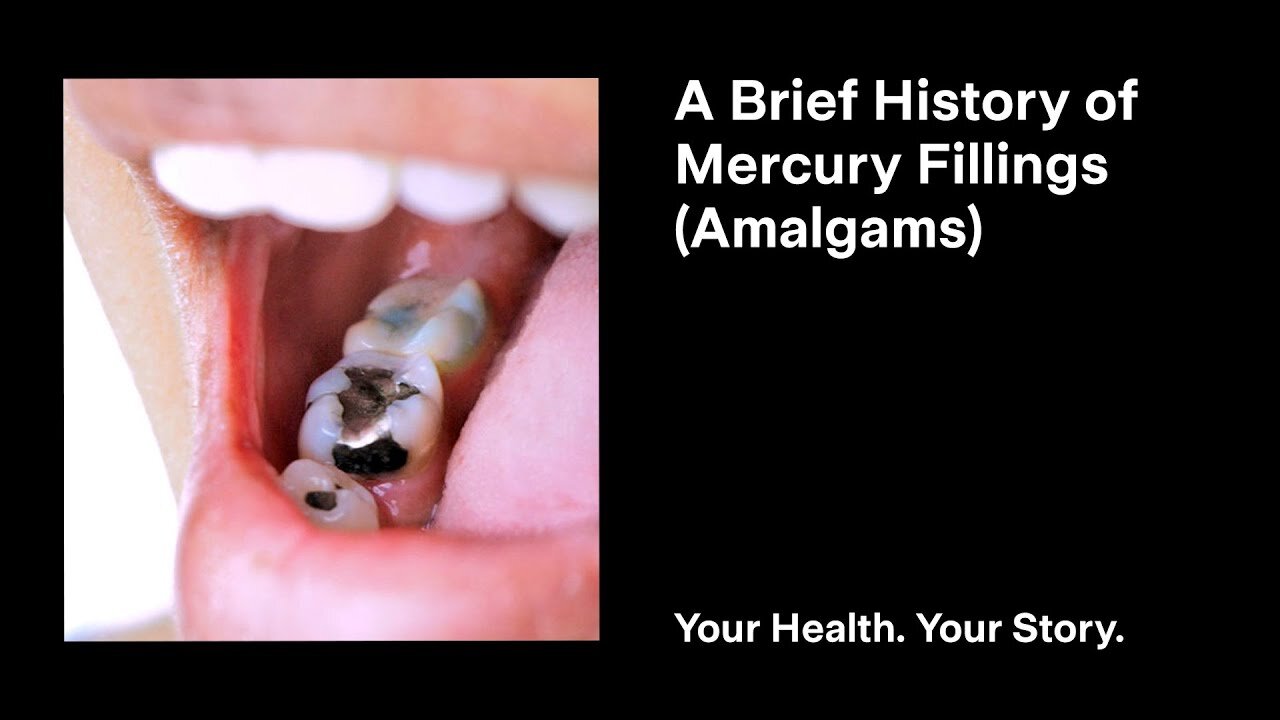 A Brief History of Mercury Fillings (Amalgams)