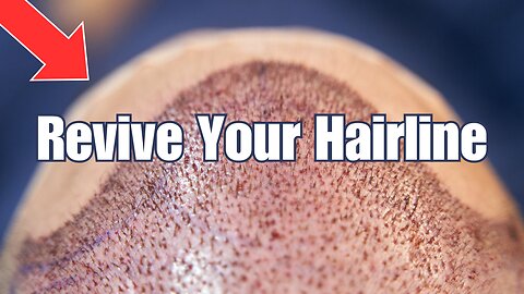 Top 10 Hair Transplant Clinics Of 2023!