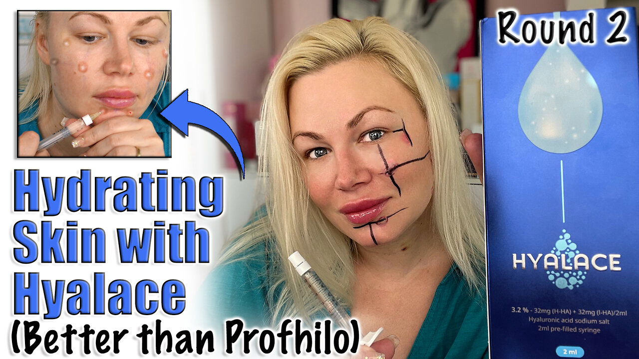 Hydrating Skin with Hyalace (Better than Profhilo from AceCosm) | Code Jessica10 Saves you Money!