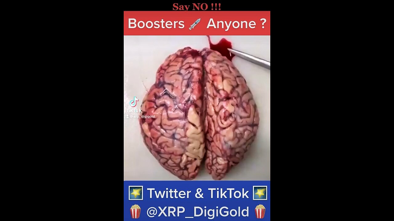 🩸🩸🩸 Blood Clots 🩸🩸🩸