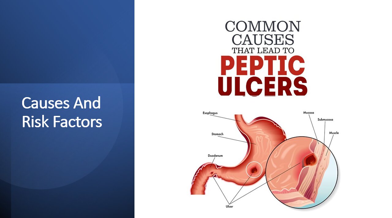 Peptic Ulcers - Causes & Risk Factors