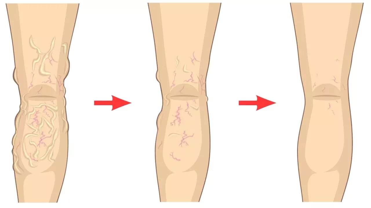 How to Get Rid of Varicose Veins Naturally