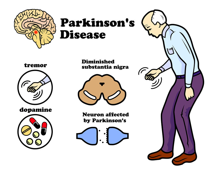 Study links mrna "vaccines" to Parkinson's disease.