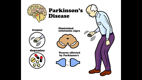 Study links mrna "vaccines" to Parkinson's disease.