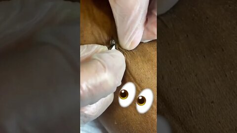 HUGE BLACKHEAD 👀