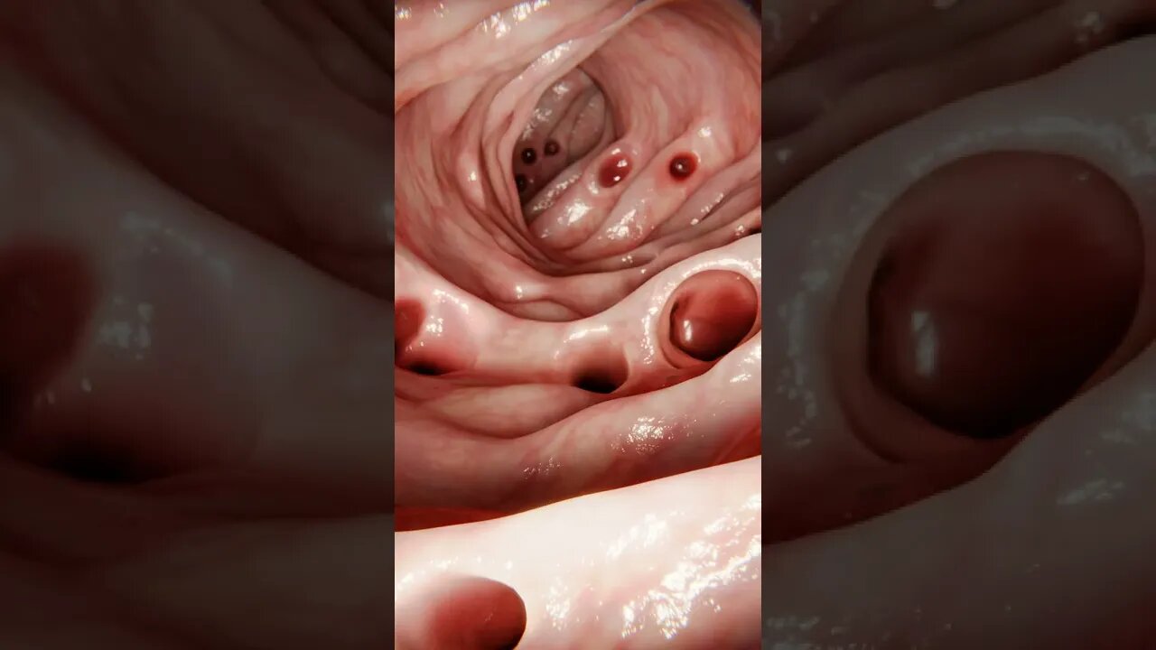 SE LIVRE DE TODAS AS FEZES PRESAS NO SEU INTESTINO COM ESTE REMÉDIO CASEIRO! #shorts