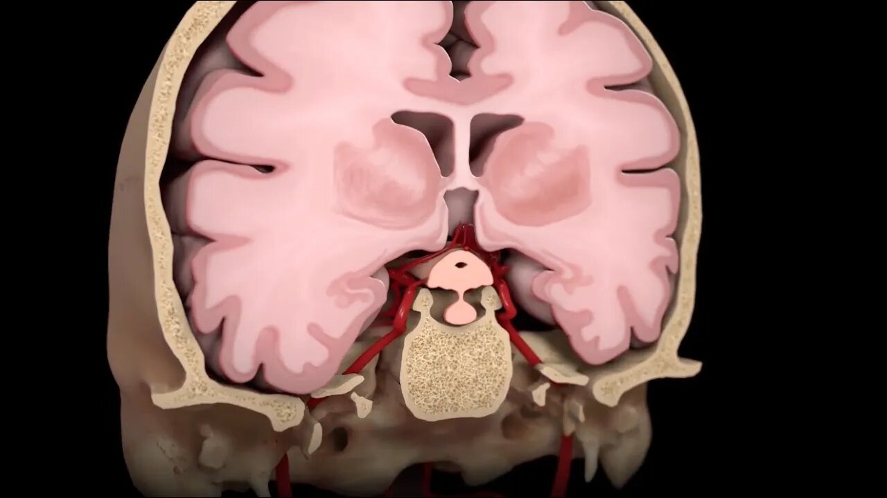 Aneurisma Cerebral