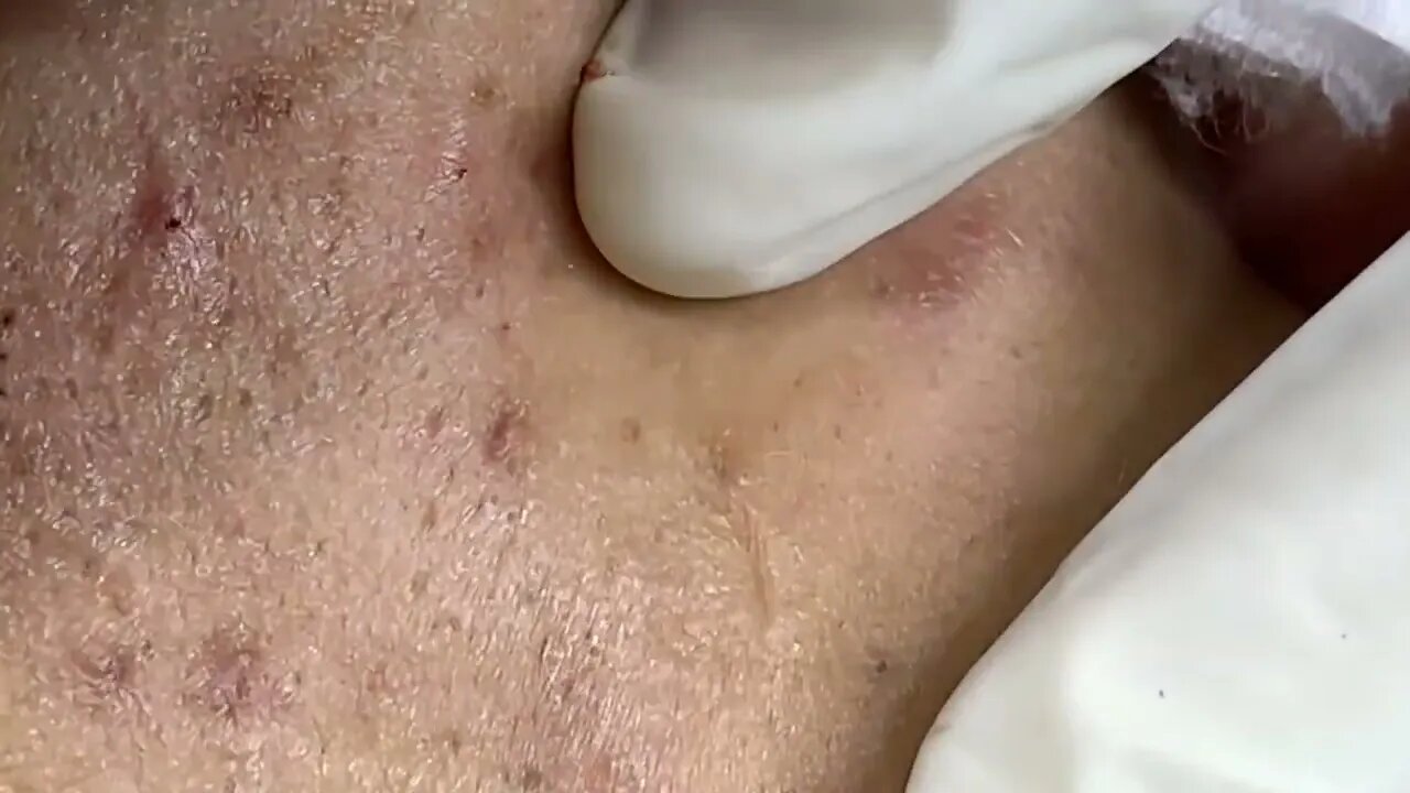 Big Cystic Acne Blackheads Extraction Blackheads & Milia, Whiteheads Removal Pimple Popping