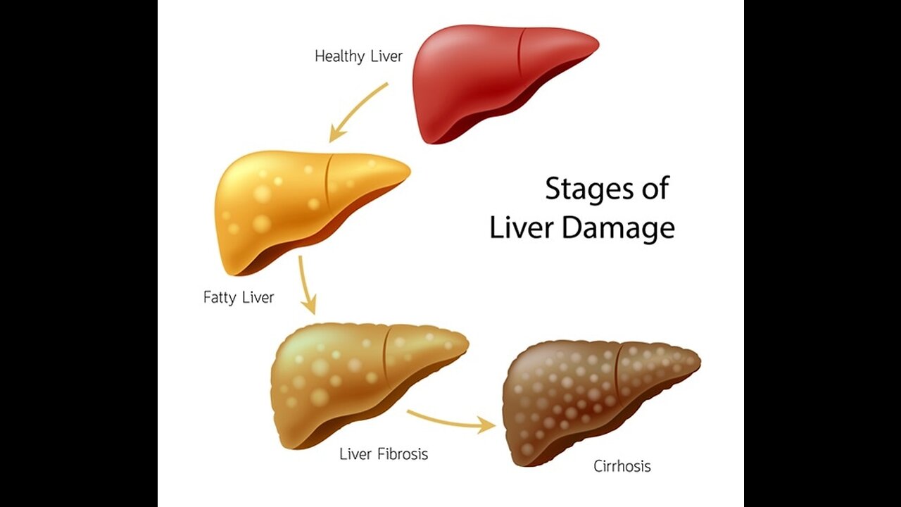 The 6 Best Ways to Heal a Fatty Liver