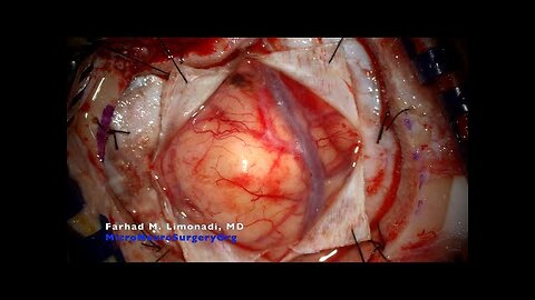 Surgery for resection of a large frontal brain tumor: Metastatic lung cancer to brain.