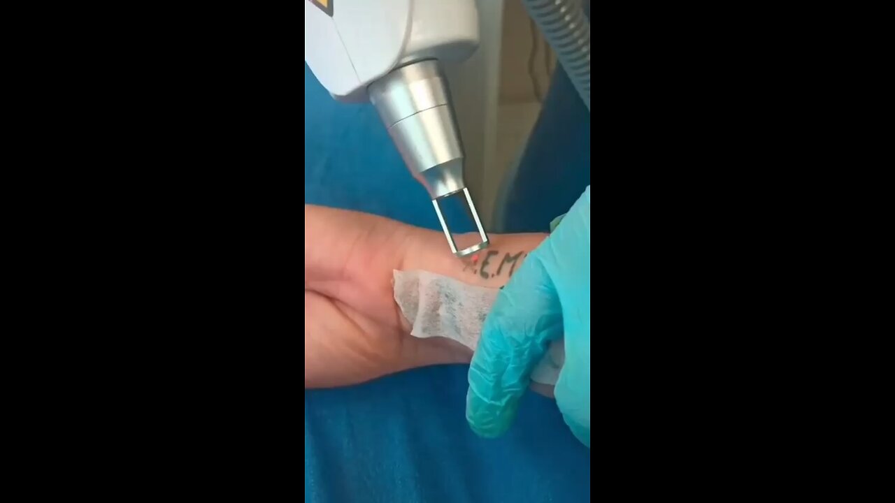 Laser Tattoo removal equipment