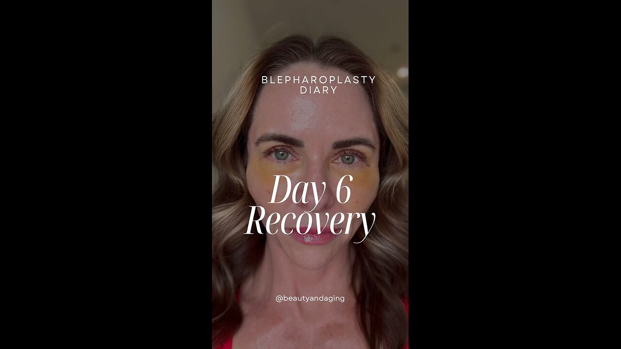 Day 6 Recovery | Eyelid Lift Surgery with Fat Transfer