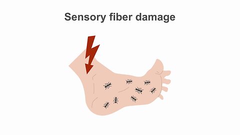 Managing diabetic neuropathy