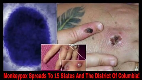 Monkeypox Spreads To 15 States And The District Of Columbia!