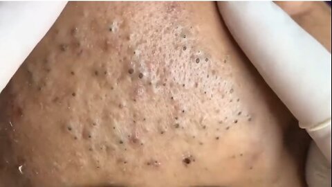 Insane Blackheads coming out!