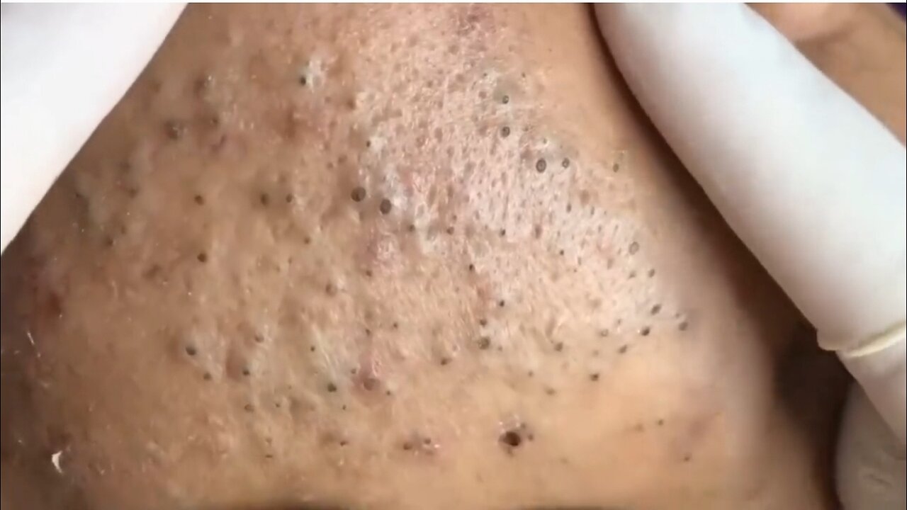 Insane Blackheads coming out!