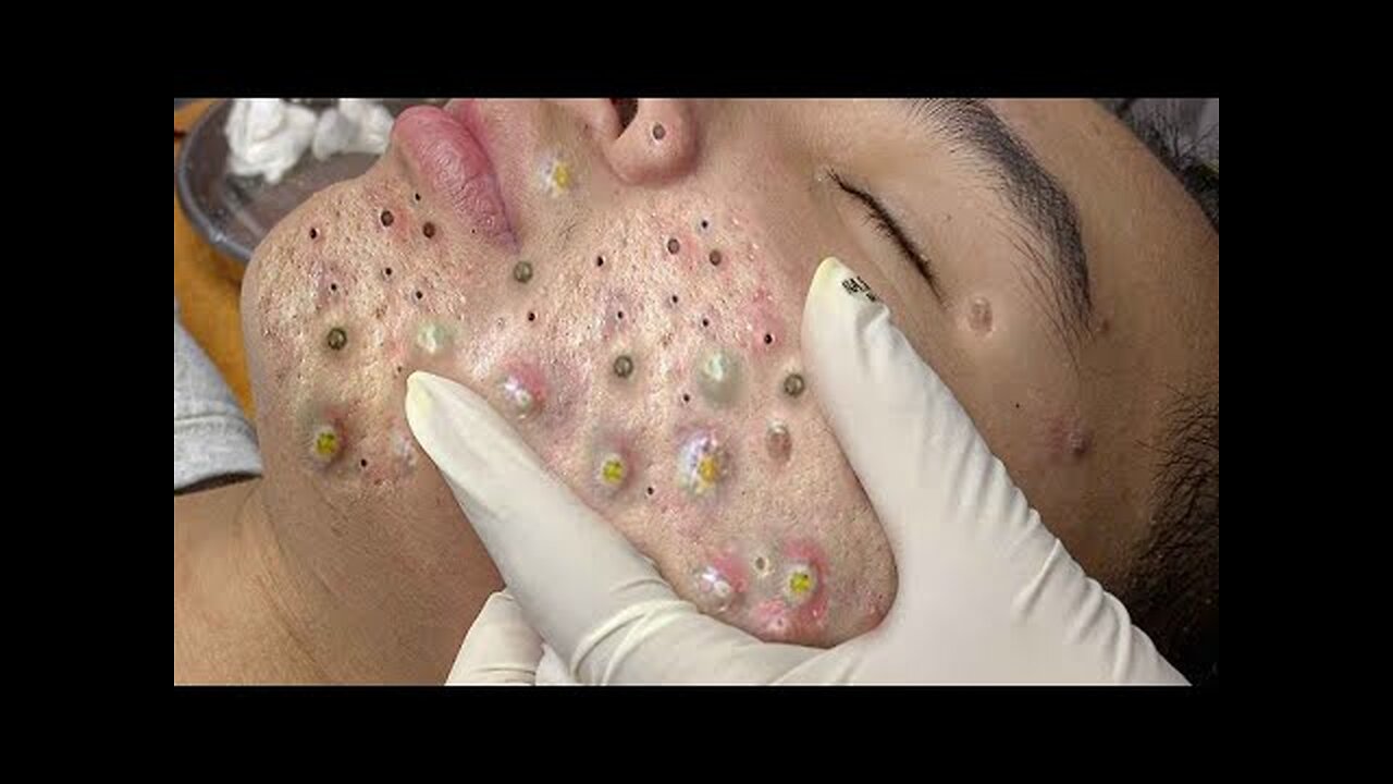 Satisfying blackhead removal, relaxing Pimple Popper 7786