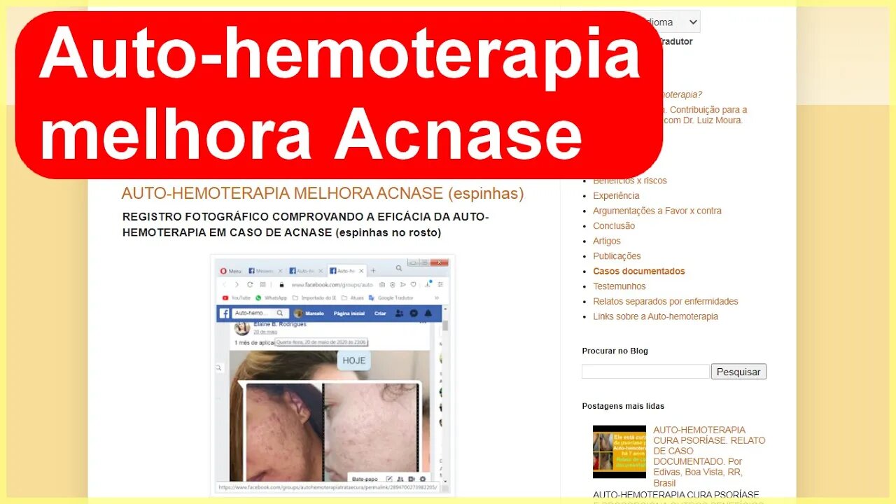 AUTO-HEMOTERAPIA MELHORA ACNASE (espinhas) por E.B.R.