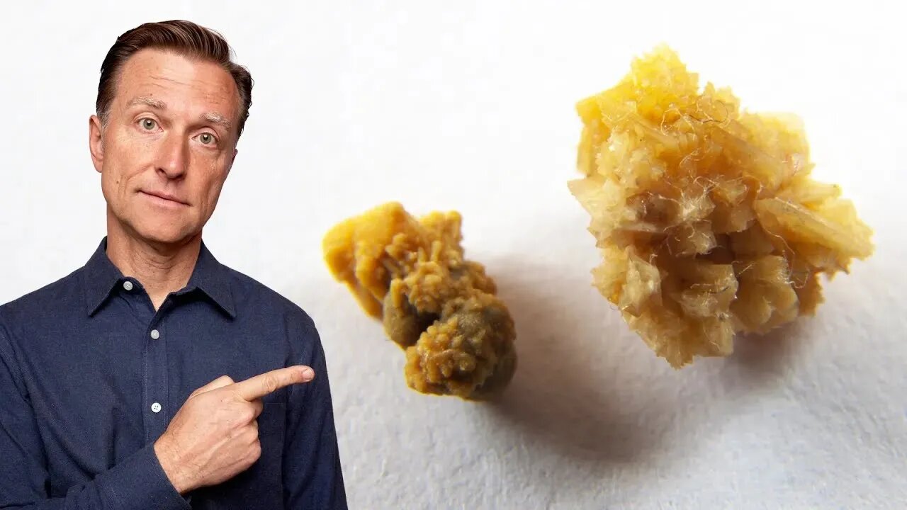 The Deeper Cause of Kidney Stones You've Never Heard About