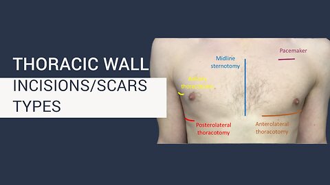 Thorax/Chest wall scars types